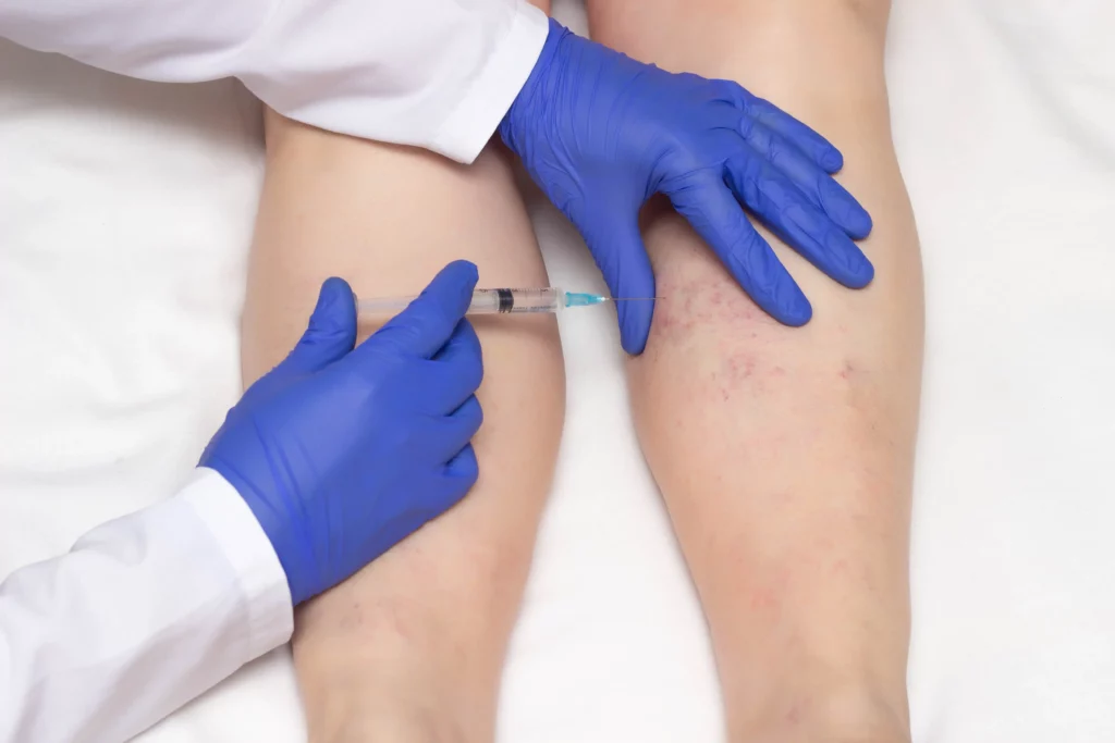 Vein Treatment in Midland, Tx at Permian Basin Med Spa & Aesthetics Center