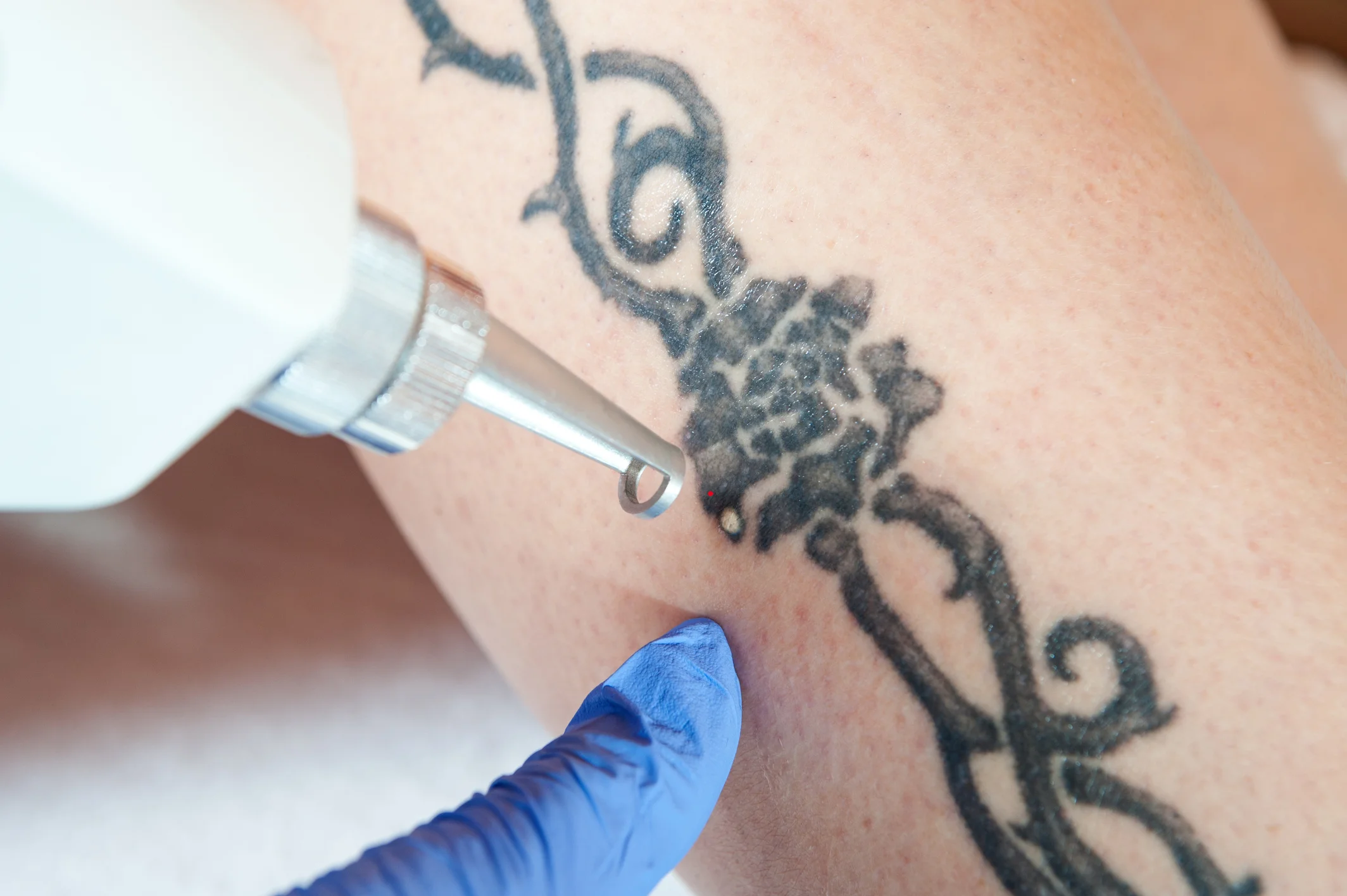 Laser Tattoo Removal in Midland, TX at Permian Basin Med Spa & Aesthetics Center