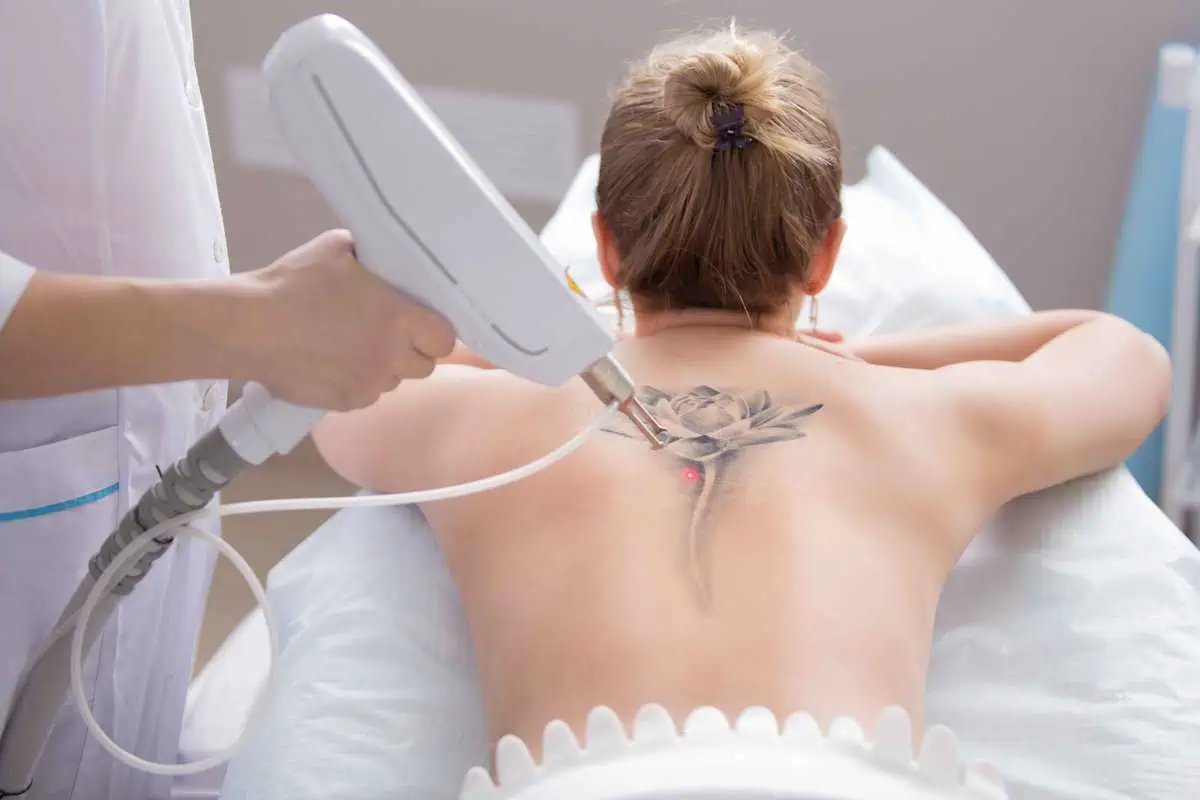 Laser Tattoo Removal at Permian Basin Med Spa & Aesthetics Center