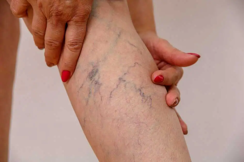 Vein Treatment in Midland, TX | Permian Basin Med Spa