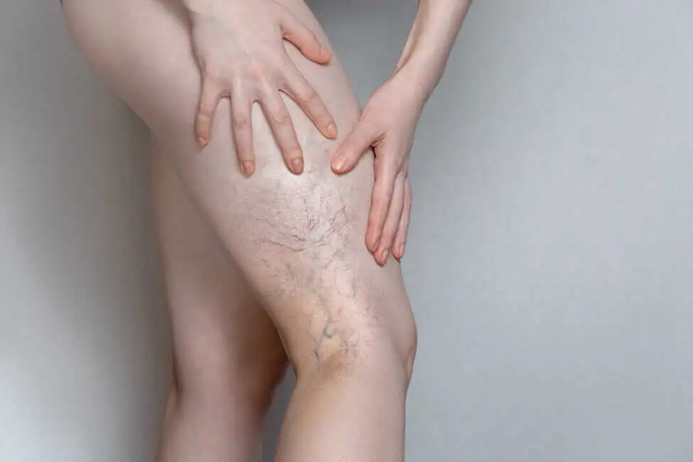 Varicose Veins by Permian Basin Med Spa and Aesthetics Center PLLC in