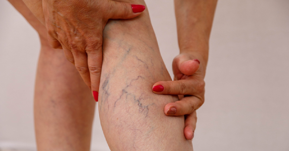 Close-up of a woman's leg showing visible varicose and spider veins, highlighting the need for Vein Treatment in Midland, TX