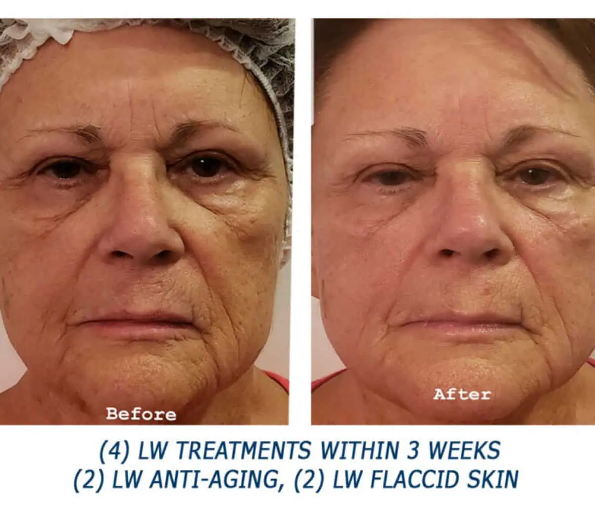 Close-up of LIGHTWAVE LED light therapy treatment at Permian Basin Med Spa in Midland TX, for skin rejuvenation and anti-aging