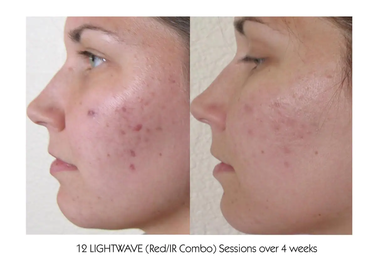 Patient receiving LIGHTWAVE LED light therapy at Permian Basin Med Spa in Midland TX for glowing and rejuvenated skin