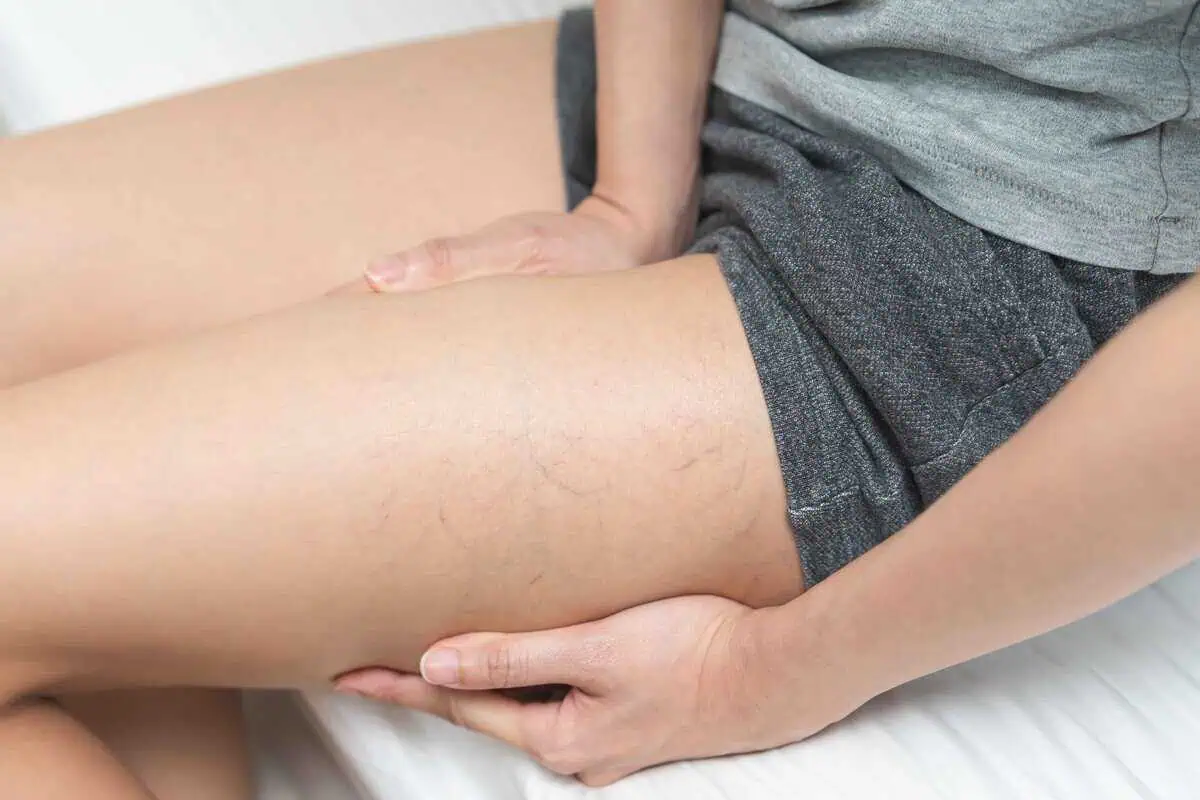 How Vein Treatment Can Improve Confidence in Midland , TX