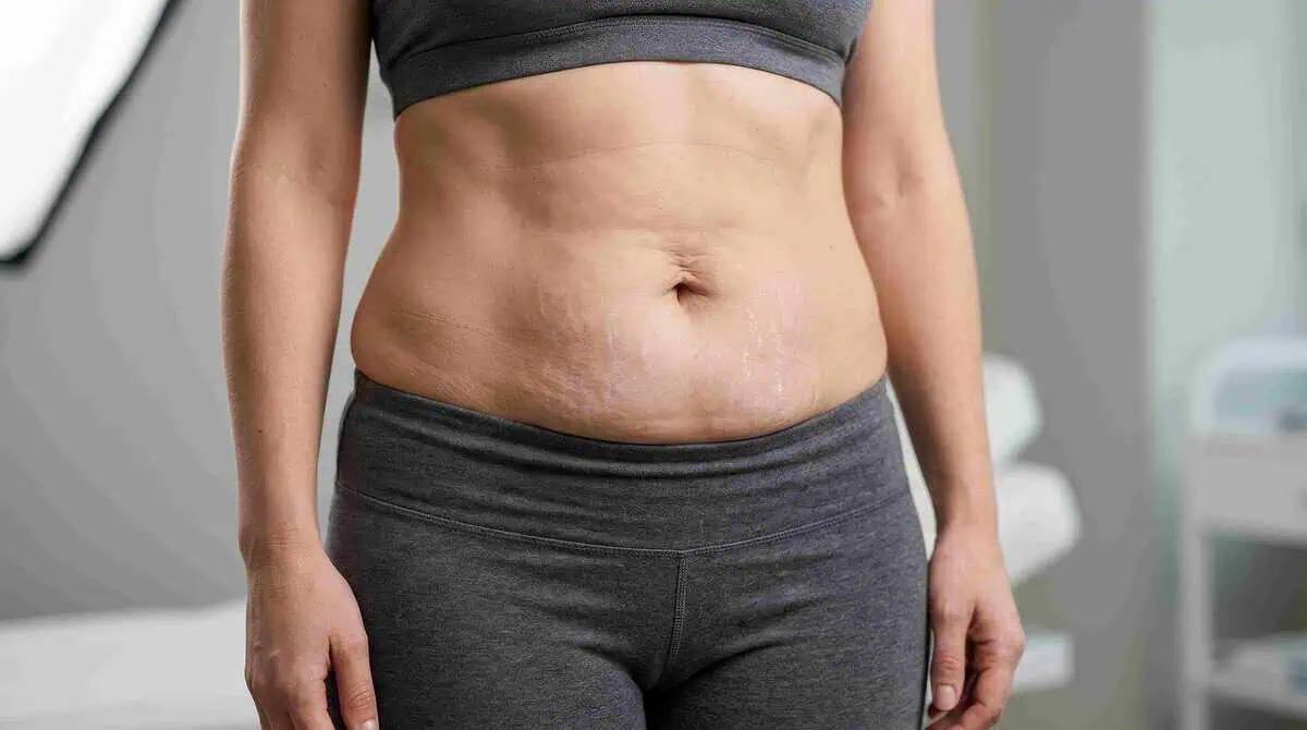 Stretch marks on the abdomen before RF microneedling treatment in Midland, TX